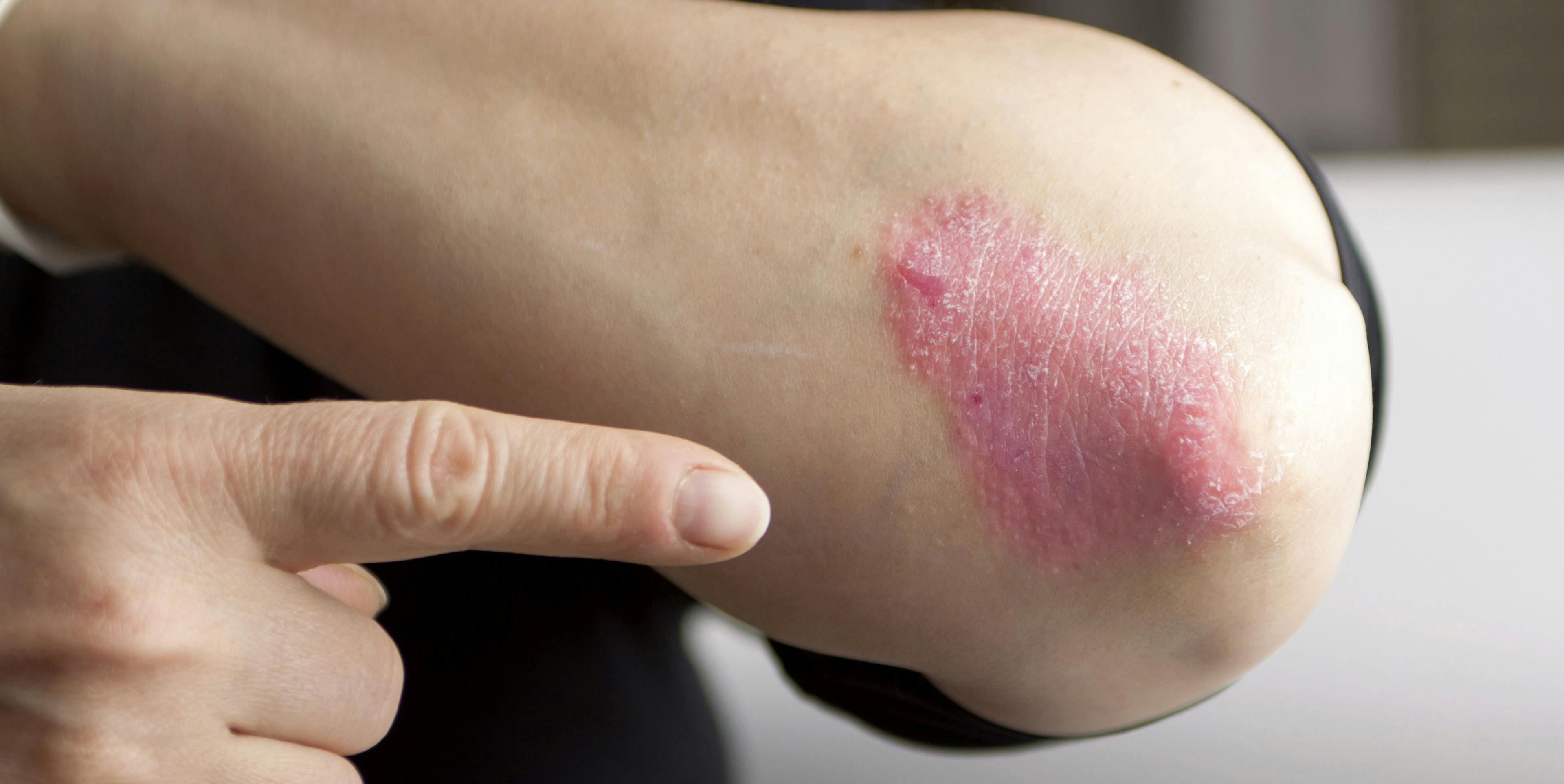 FDA Approves New Psoriasis Treatment