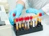 Men Favor Prostate Cancer Test Despite Task Force Recommendation