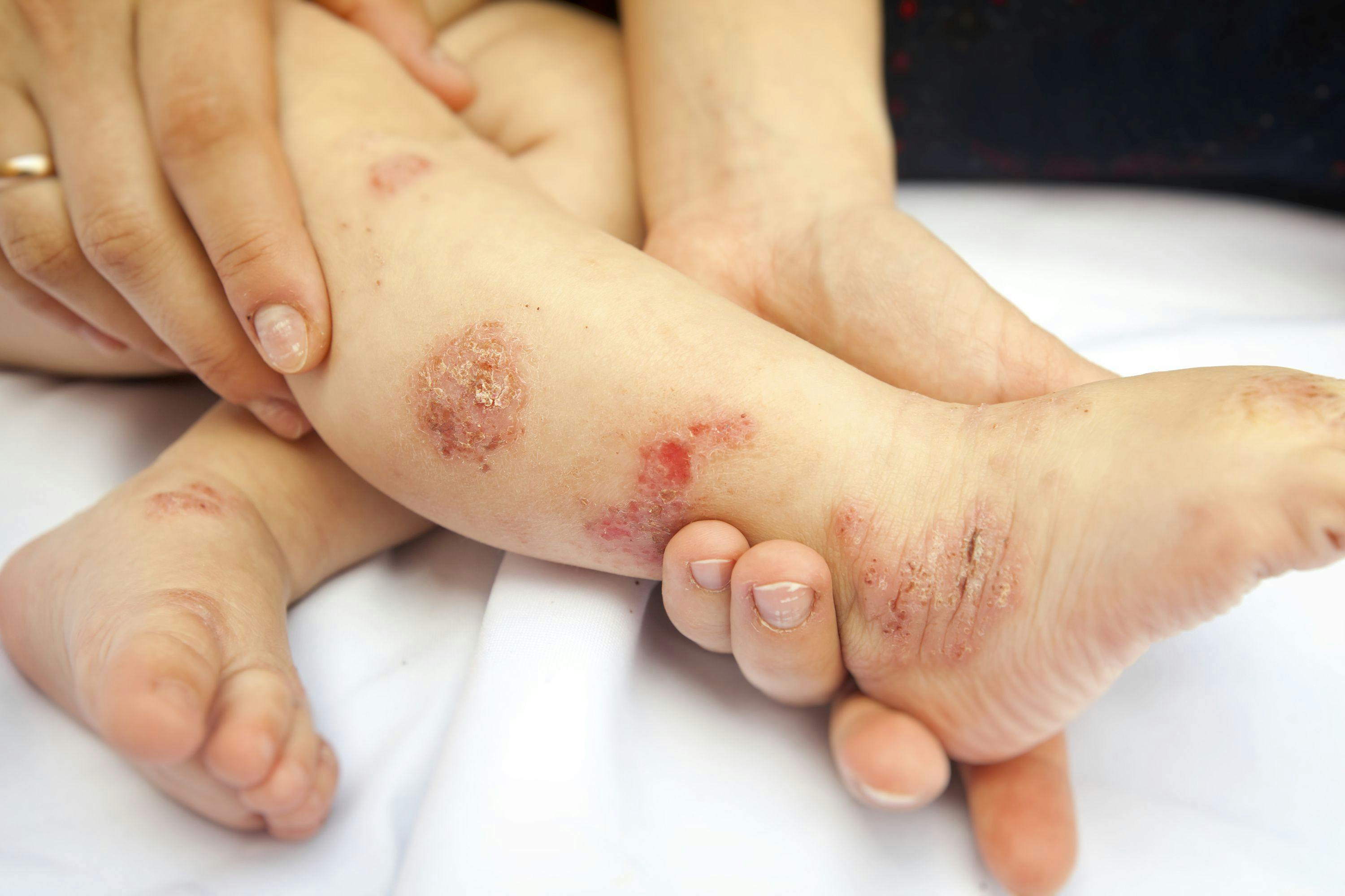 Child with dermatitis