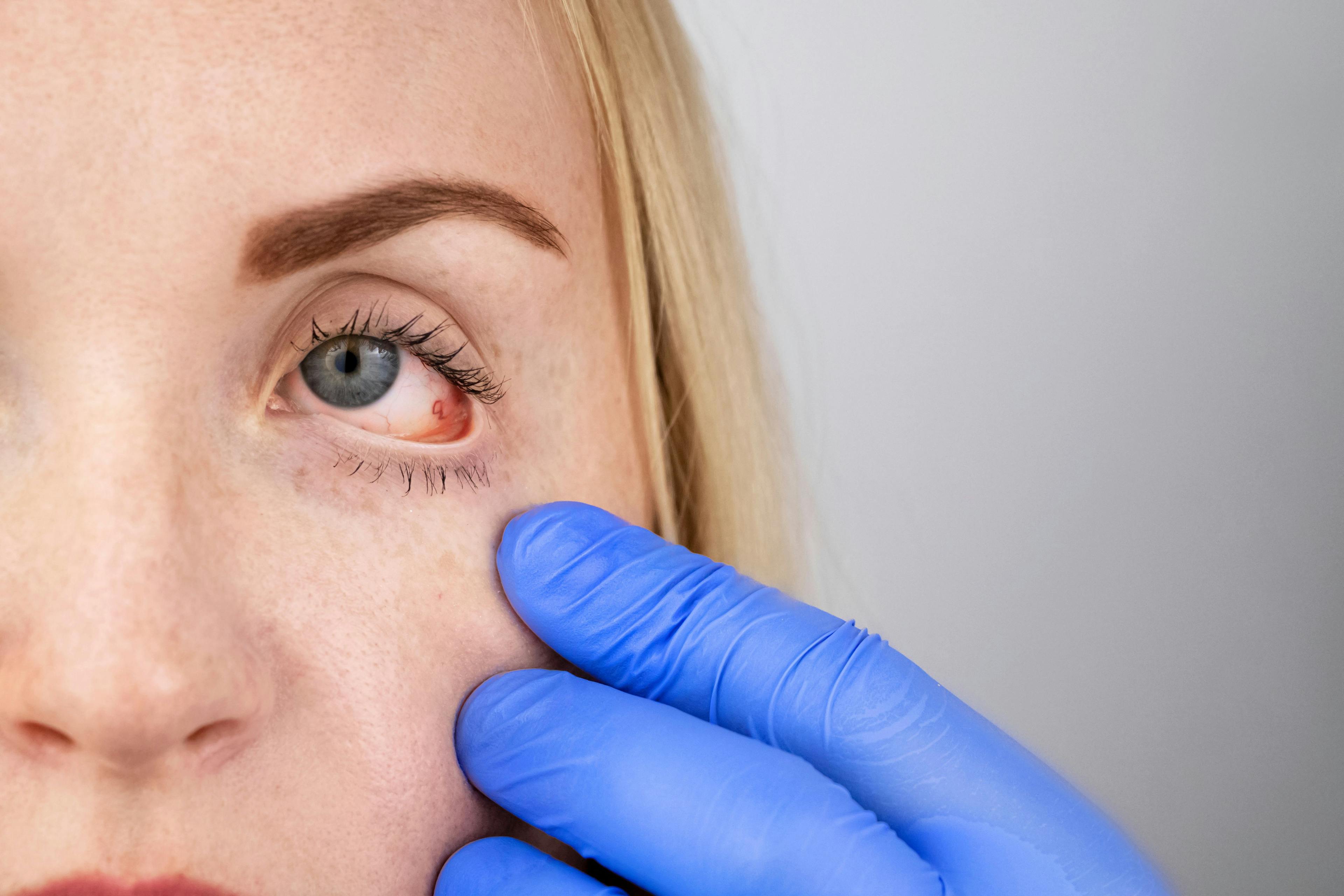 An ophthalmologist examines a woman who complains of a burning sensation and pain in her eyes. Eye fatigue from a computer screen or telephone (sand sensation on the cornea)