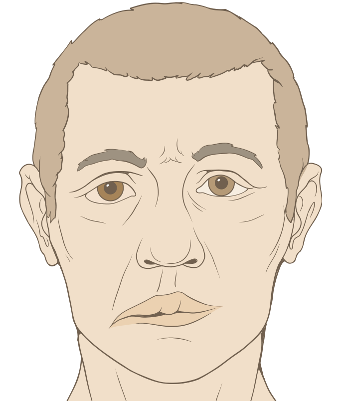 Pharmacy Clinical Pearl of the Day: Bell’s Palsy 