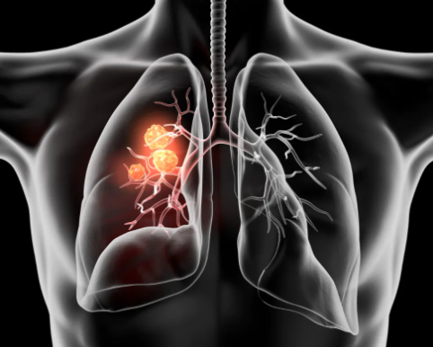 New Therapeutic Options Can Prolong Survival in Patients with Mutated Non-Small Cell Lung Cancer