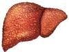 HCV-Related Liver Cancer Rates Rise as Other Cancers Fall