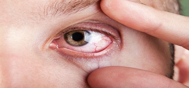 FDA Approves Short-Term Treatment for Dry Eye Disease Symptoms