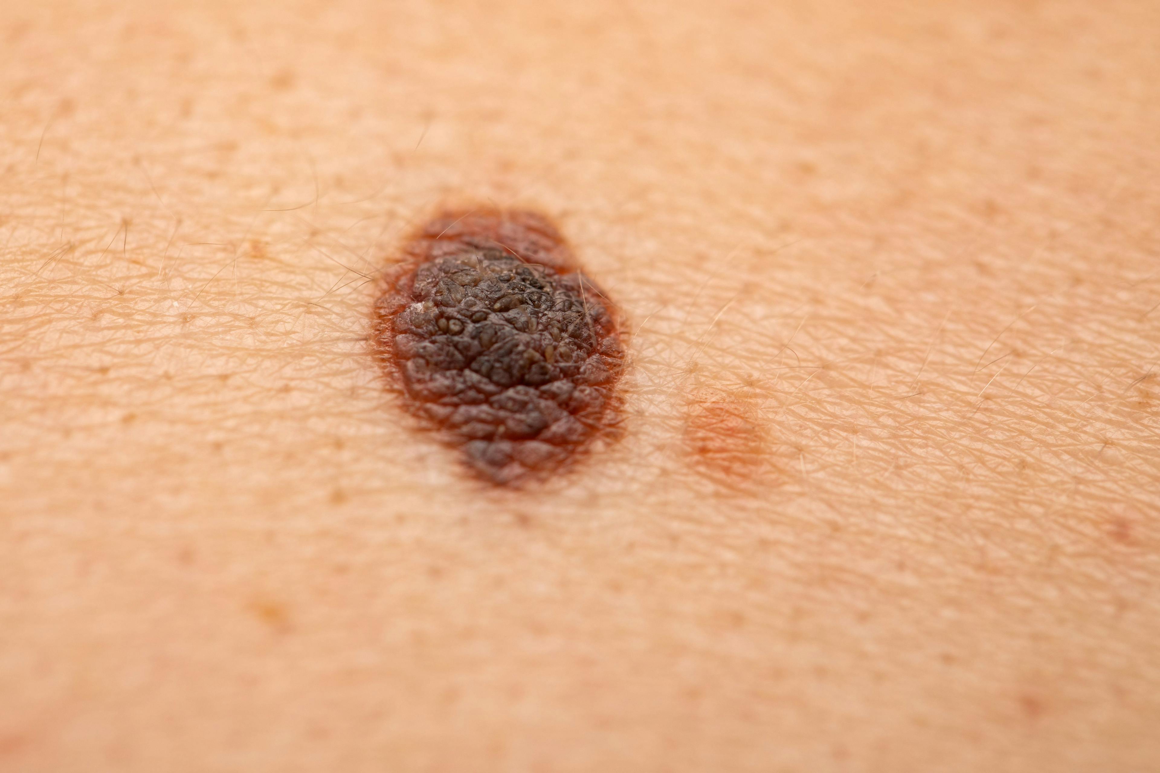 Dangerous nevus on skin - melanoma | Image Credit: Ocskay Mark - stock.adobe.com
