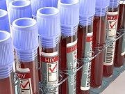 HIV Infection Can Cause Patients to Age Faster