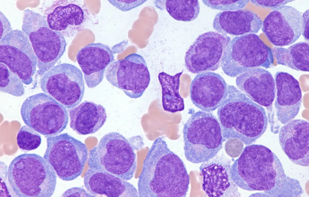 Study: Venetoclax Plus Hypomethylating Agent Effective in Newly Diagnosed Acute Myeloid Leukemia, Safe in Outpatient Setting
