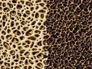 Bone Marker Test May Indicate Adherence to Osteoporosis Drugs