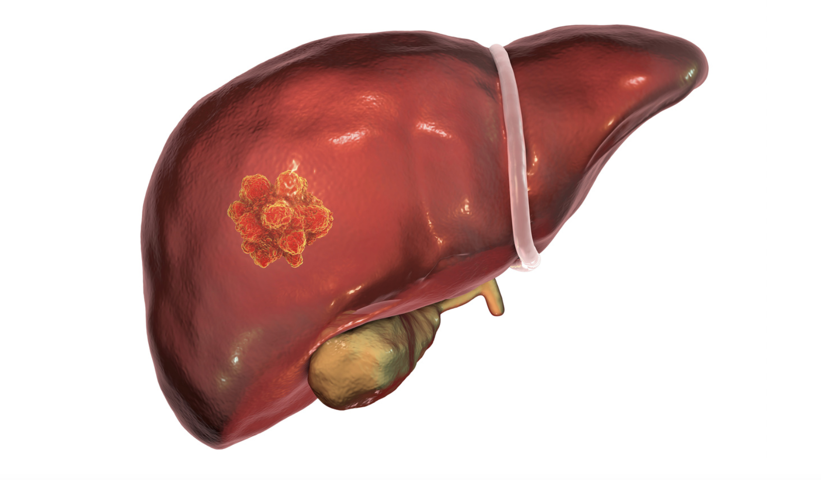 Study Finds Folfirinox is Well Tolerated, Potentially Effective in First-Line Treatment of Biliary Tract Cancer