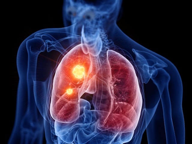Tumor in lungs -- Image credit: Sebastian Kaulitzki | stock.adobe.com