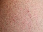 Dupilumab Shows Efficacy Treating Atopic Dermatitis