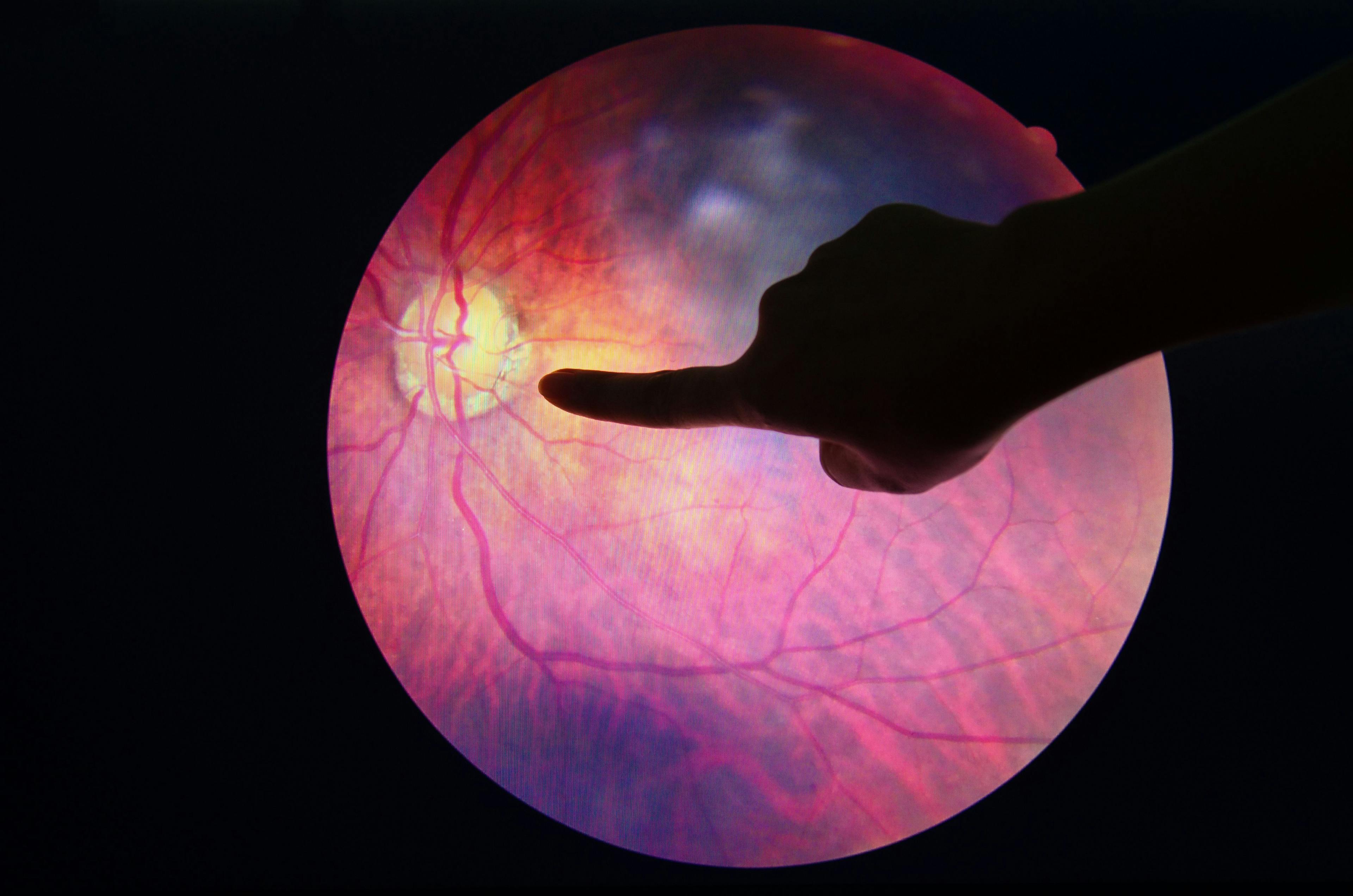 FDA Approves First Ophthalmology Biosimilar for Neovascular Age-Related Macular Degeneration