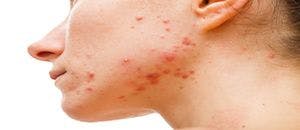 Study: Acne Treatment Disproportionately Affects Women, People With Darker Skin