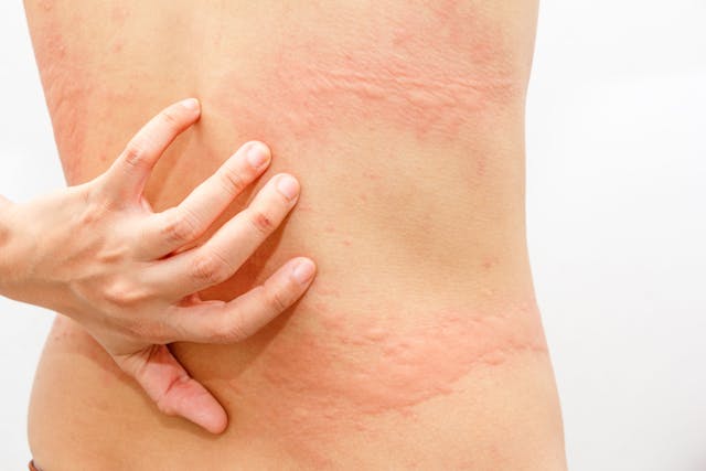 Women with symptoms of itchy urticaria.- Image credit: Kanachaifoto | stock.adobe.com 