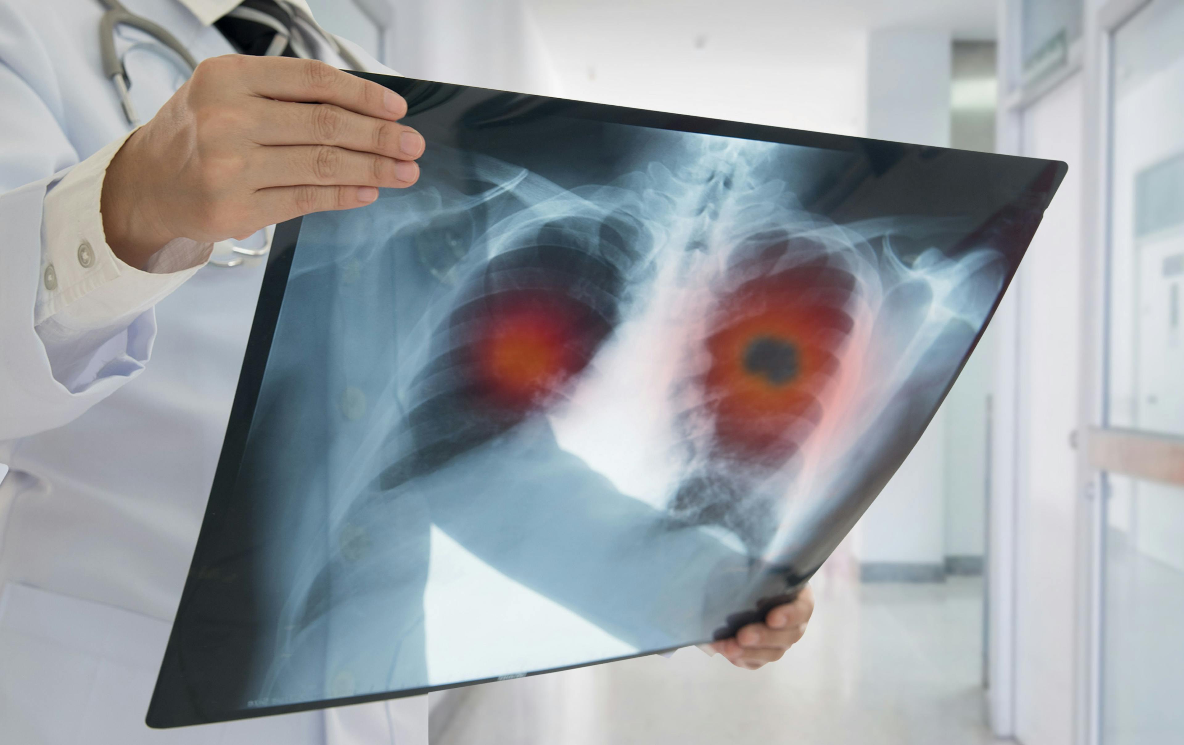 Health care worker examining lung x-ray