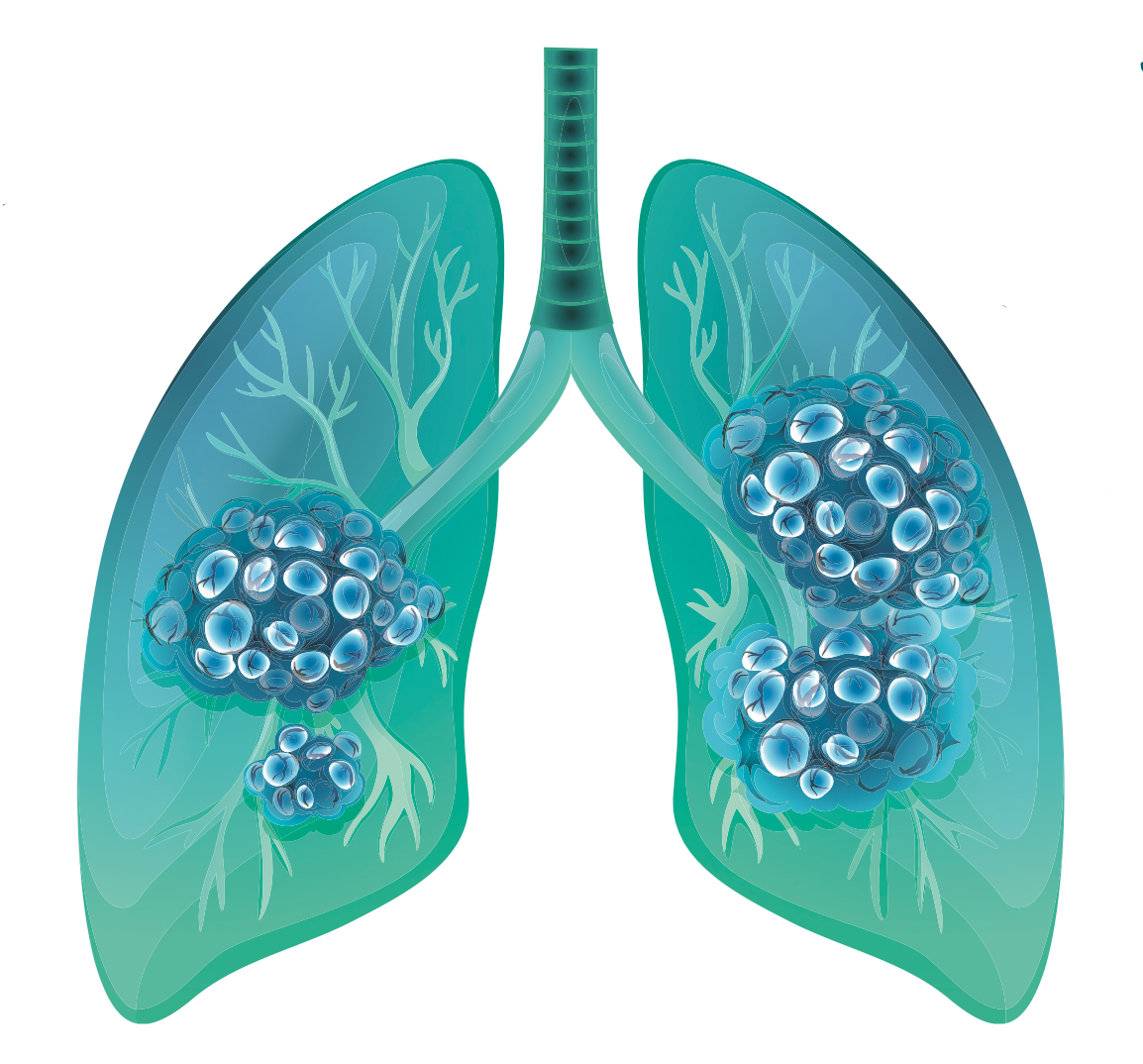 Lung Cancer Study Brings Pharmacists to the Forefront of Patient Care