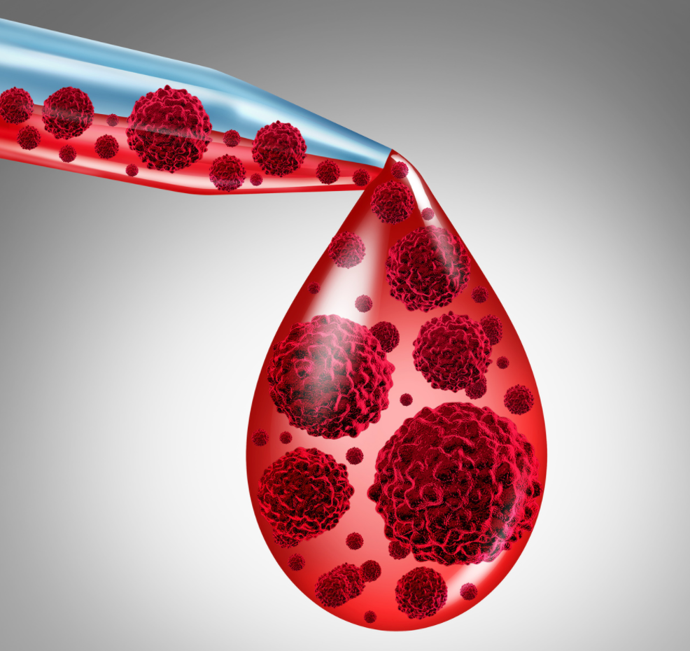 Brentuximab Vedotin Combo Lowers Risk of Death in Patients With Hodgkin Lymphoma