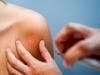 Prescription Drug Linked to Increased Skin Cancer Risk