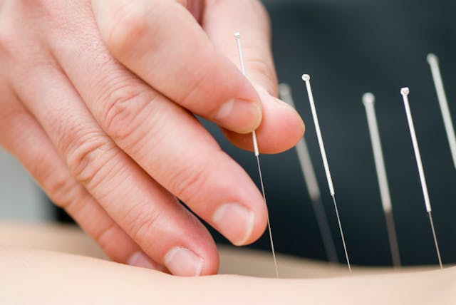 Treatment by acupuncture | Image Credit: Max Tactic - stock.adobe.com