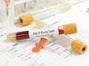 Experimental Drug May Offer Effective Hepatitis B Treatment