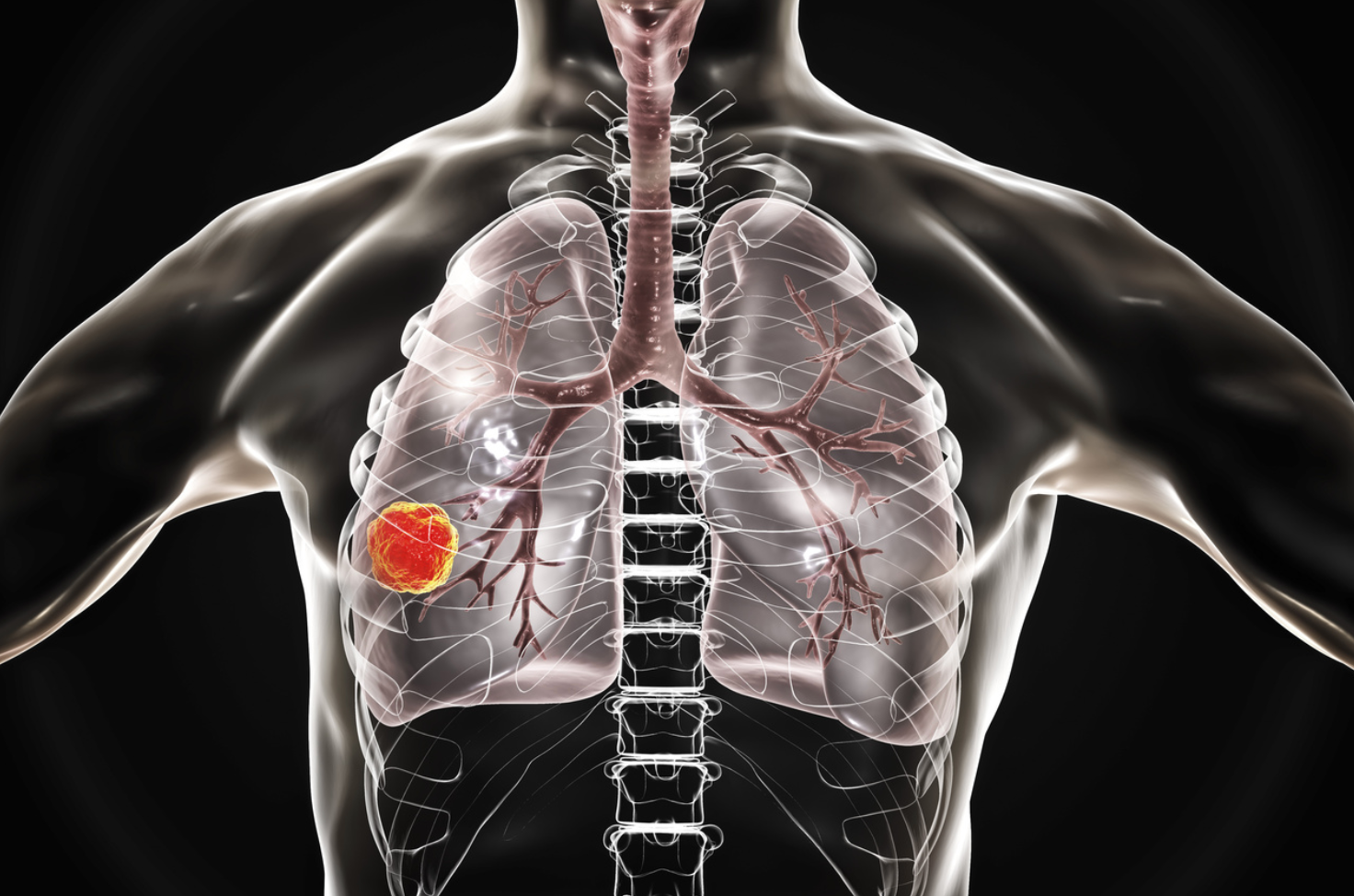 Sotorasib Granted FDA Priority Review for Non-Small Cell Lung Cancer