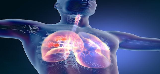 Research Finds Decrease in Lung Cancer Screenings, Increase in Malignancy During COVID-19 Pandemic