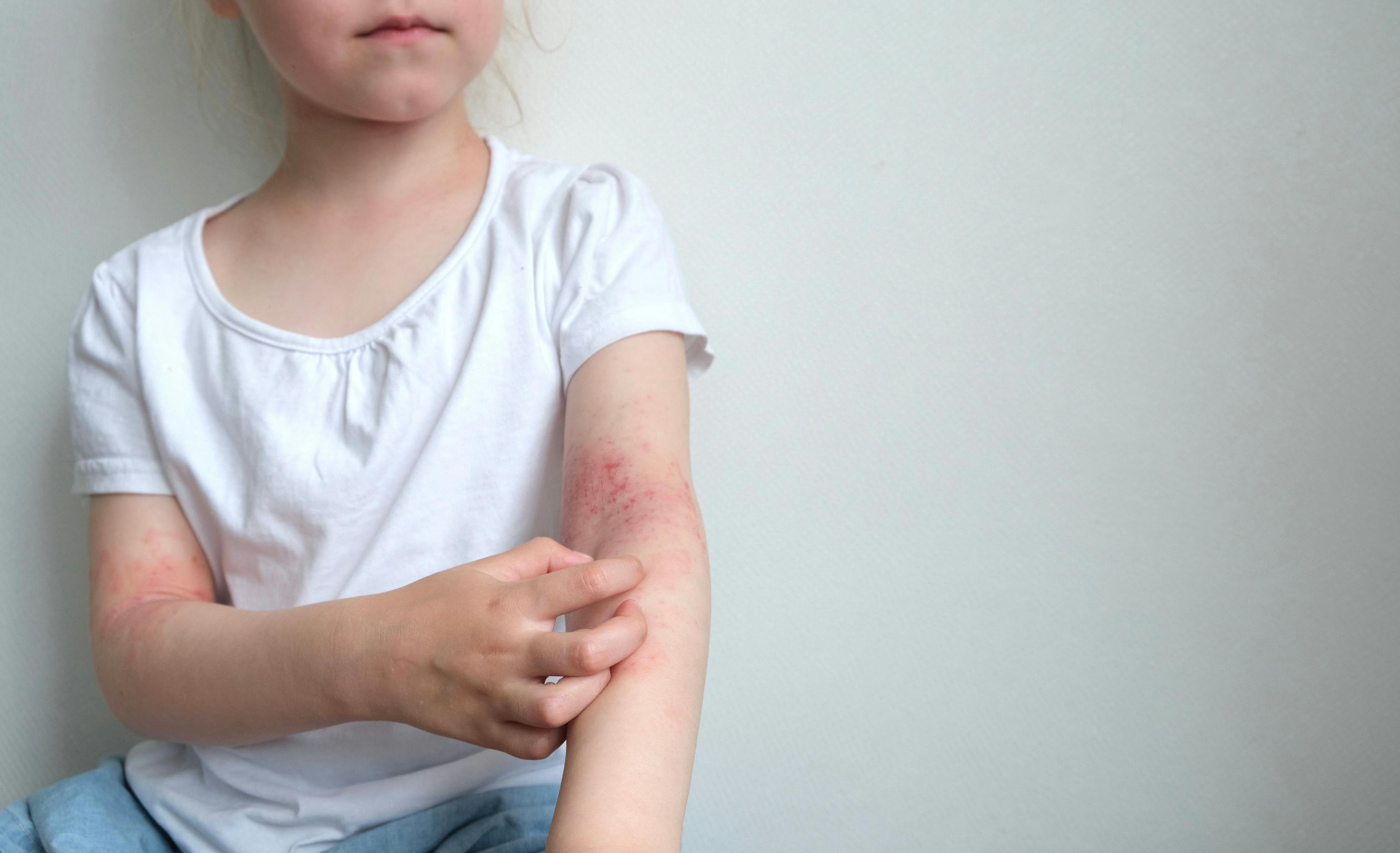 Can We Do More for Topical Therapy in Pediatric Atopic Dermatitis?