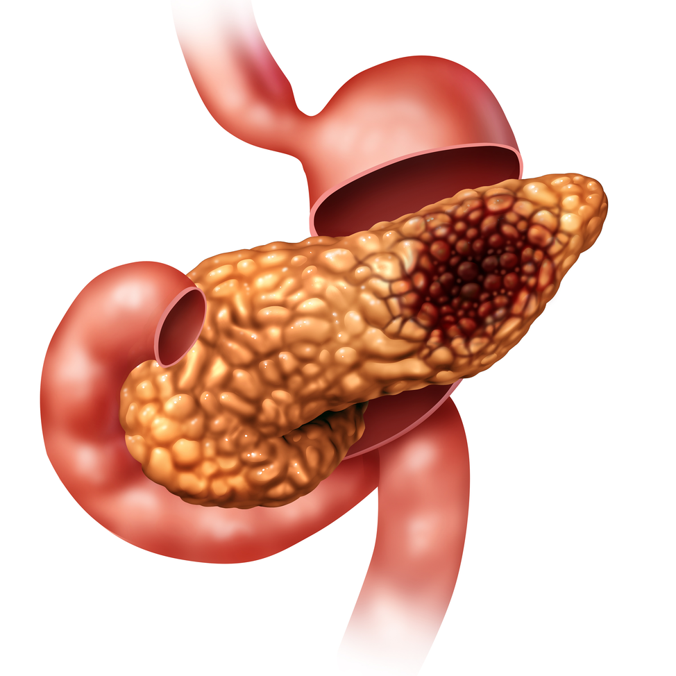 Risk Prediction Model Could Identify Patients With a Higher Risk of Pancreatic Cancer