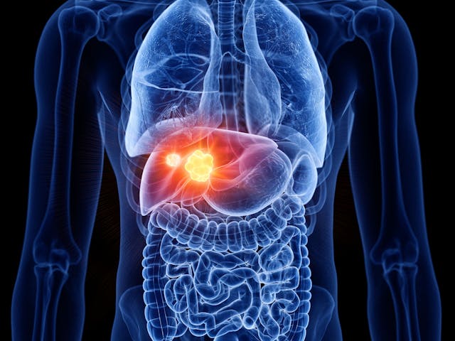 3d illustration of liver cancer -- Image credit: SciePro | stock.adobe.com