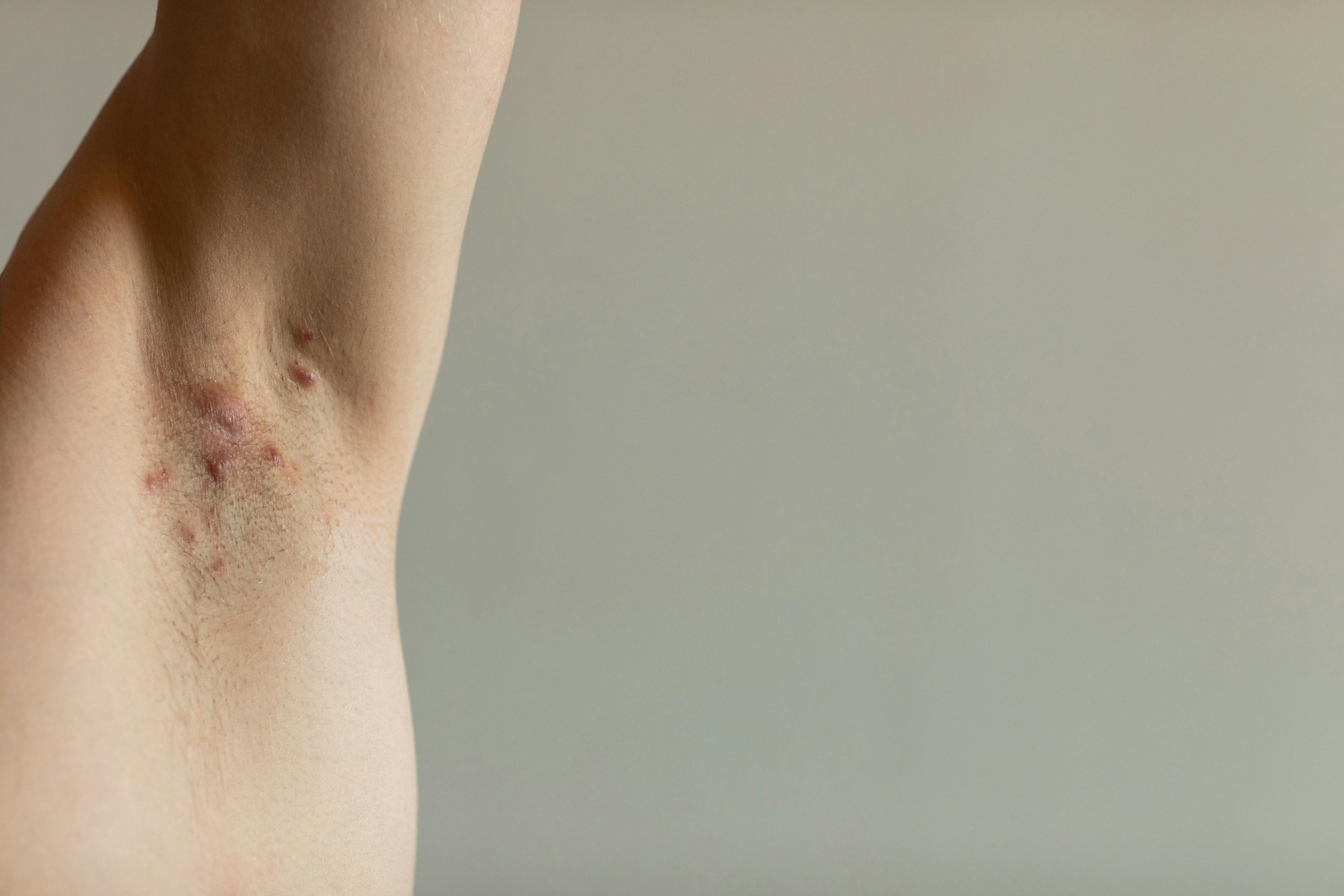 Patient with hidradenitis under armpit -- Image credit: Lea | stock.adobe.com