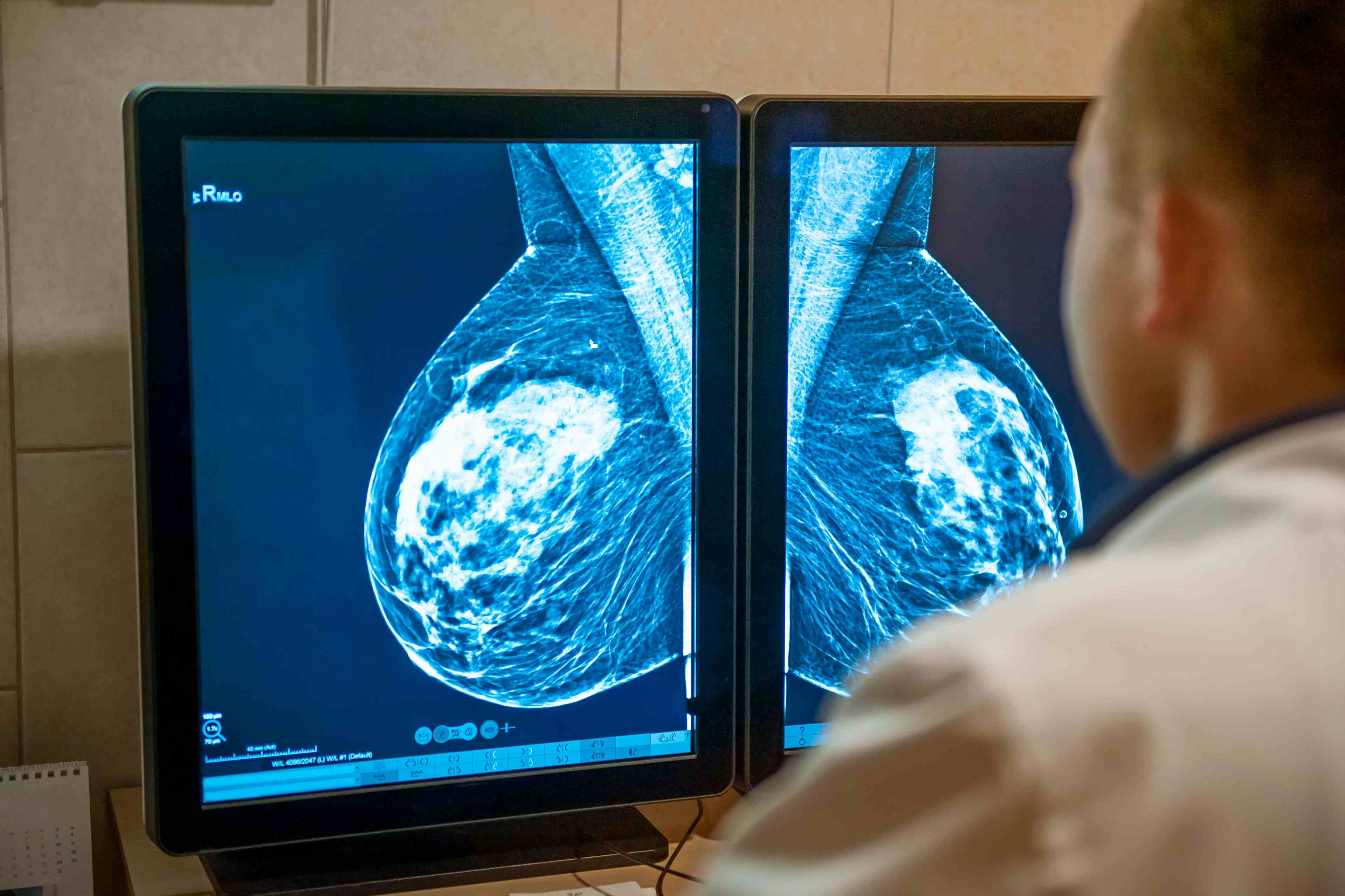 Doctor examines mammogram snapshot of breast of female patient on the monitors | Image Credit: okrasiuk - stock.adobe.com