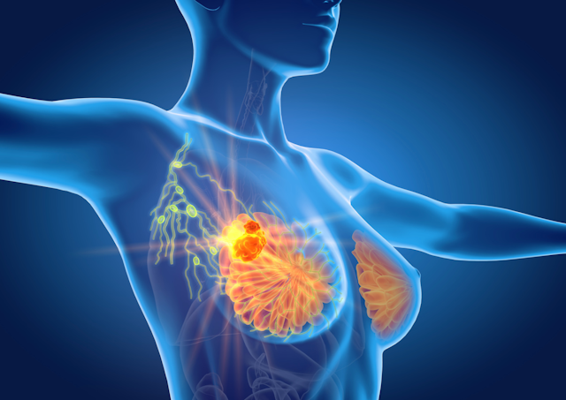 Immunotherapies, PARP Inhibitors Show Promise in Early Stage, Triple-Negative Breast Cancers