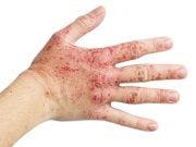 Researchers Discover Eczema Subtypes
