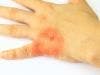 Missed Opportunities in Communicating CVD Risks to Psoriasis Patients