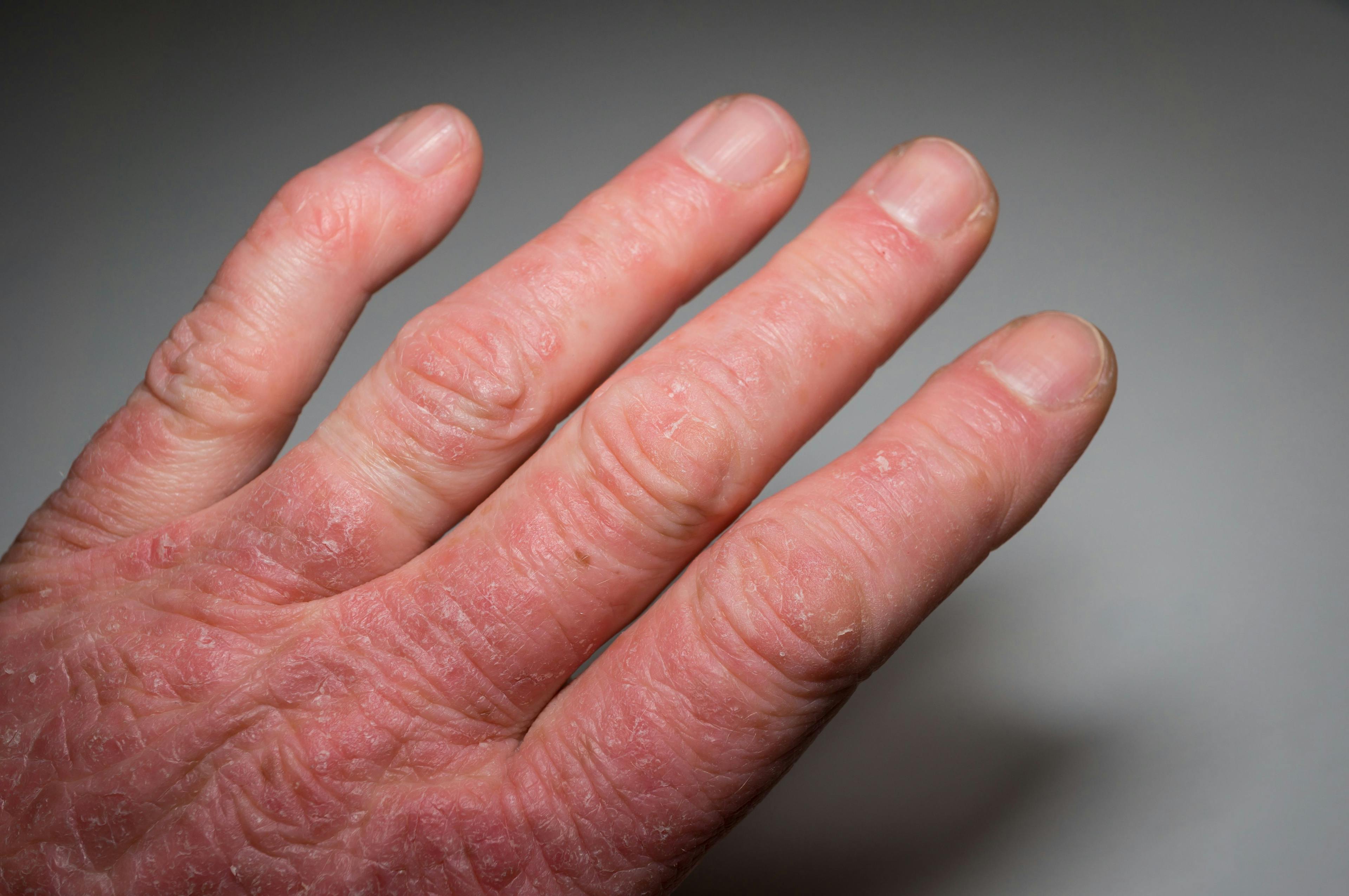 FDA Approves Abrocitinib for Adults with Moderate to Severe Atopic Dermatitis