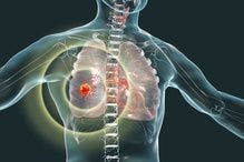 Long-Term Review Supports Pembrolizumab with Etoposide/Platinum for First-Line Small Cell Lung Cancer