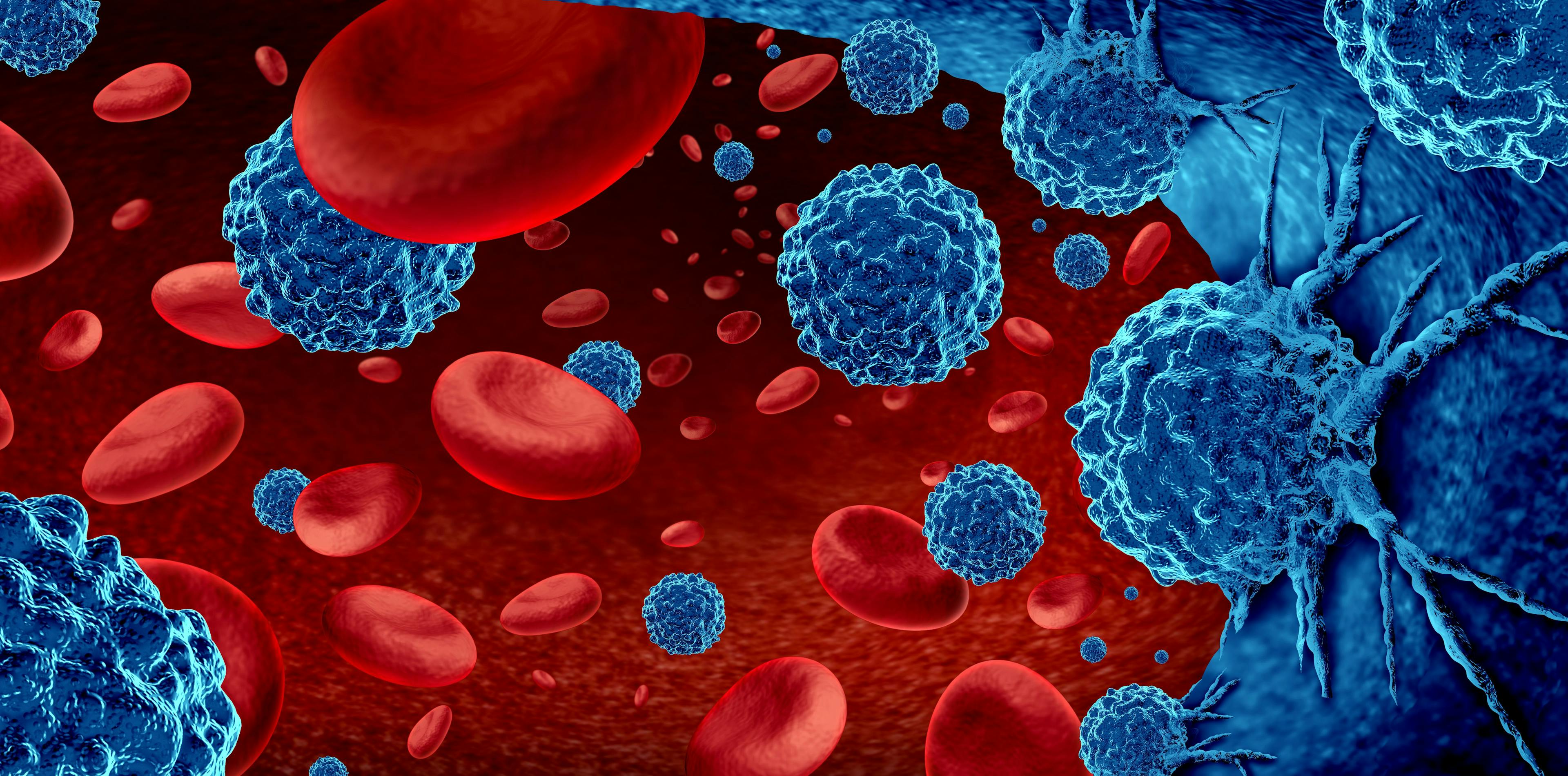 Cancer in the blood outbreak and treatment for malignant cells in a human body caused by carcinogens and genetics with a cancerous cell as an immunotherapy and leukemia or lymphoma symbol and medical | Image Credit: freshidea - stock.adobe.com