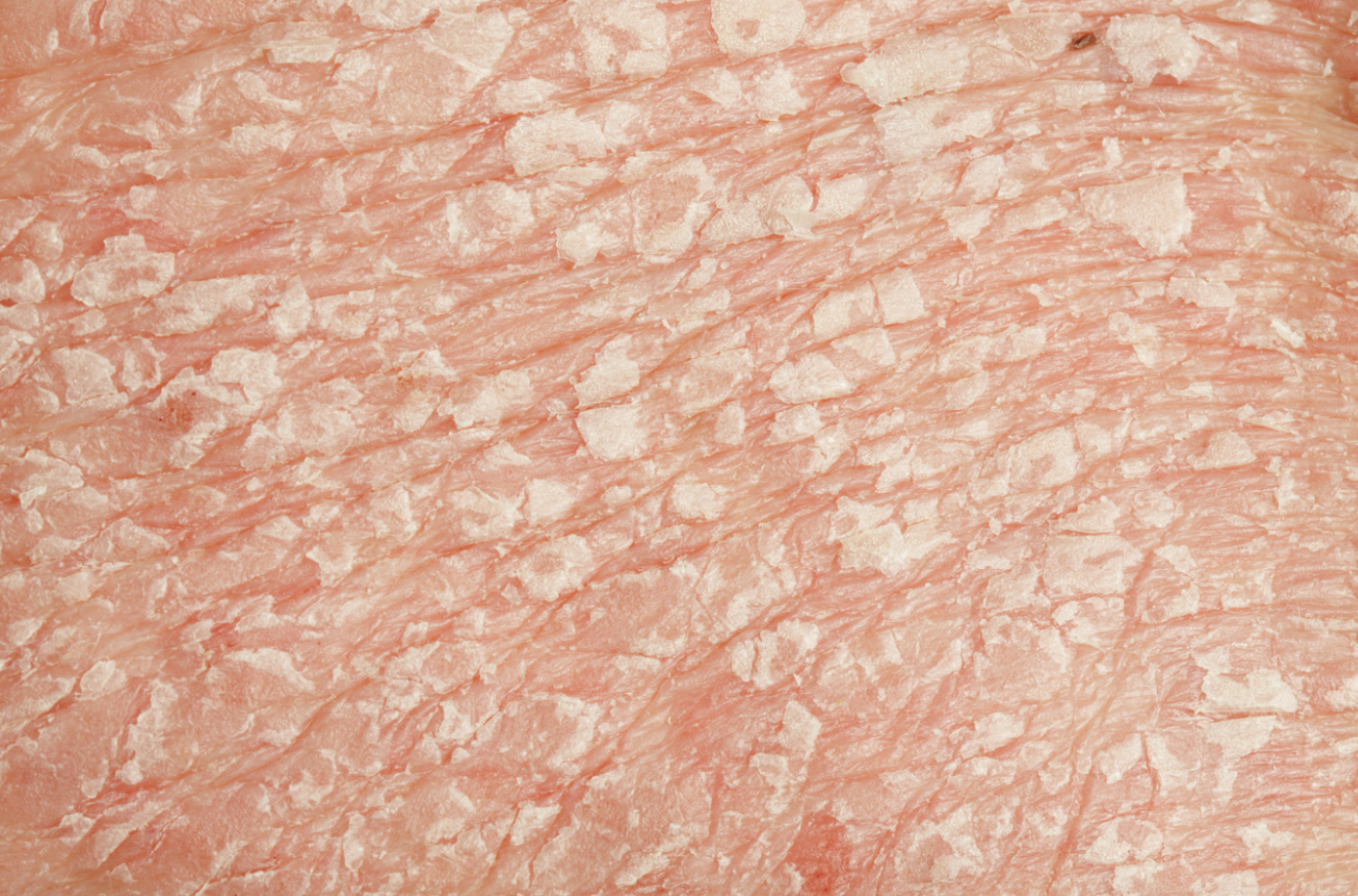 Guselkumab Shows High Levels of Skin Clearance in Moderate-to-Severe Plaque Psoriasis