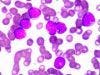 New Treatment Target for Acute Myeloid Leukemia
