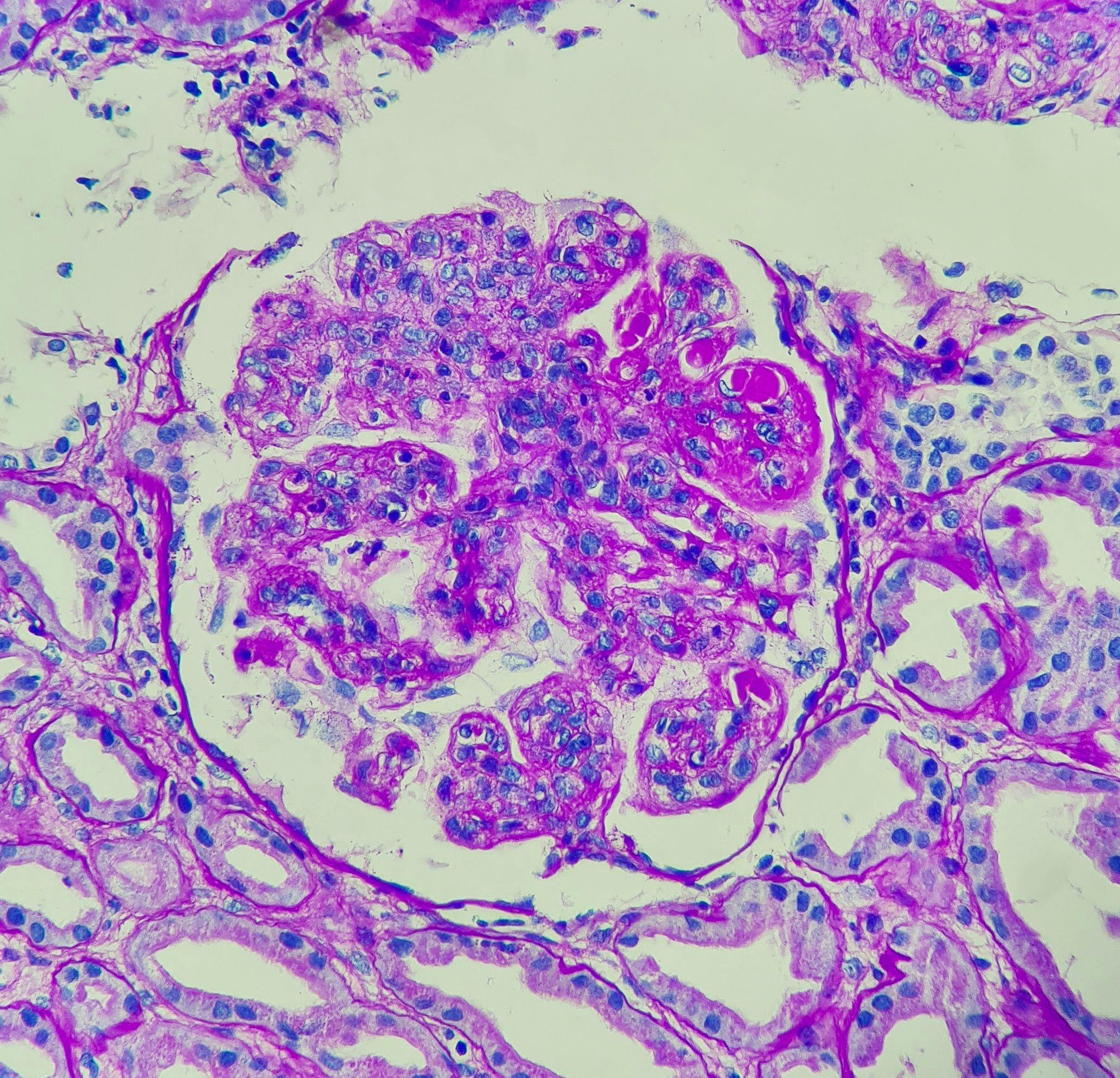 Photo of lupus nephritis, showing wire loop and hyaline thrombi, PAS stain, magnification 400x, photo under microscope - Image credit: Chutima | stock.adobe.com