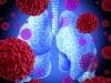 Lung Cancer Treatment Granted Orphan Drug Status