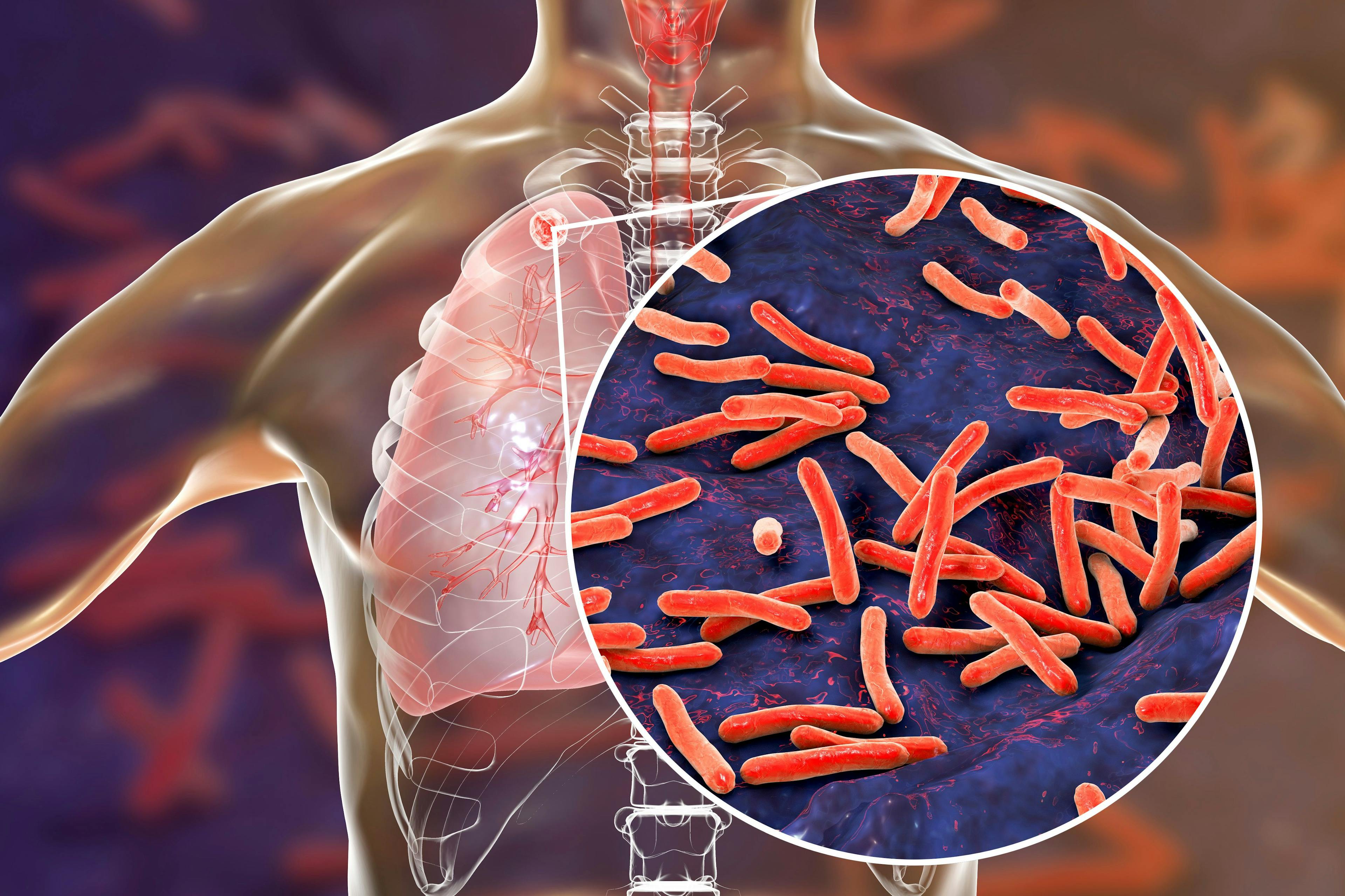Mycobacterium tuberculosis bacteria in the lungs -- Image credit: Dr_Microbe | stock.adobe.com
