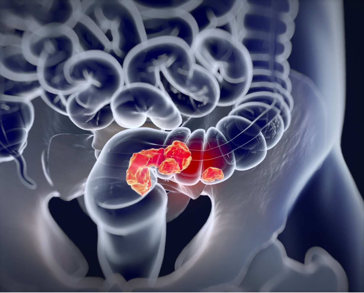 Incidence of Colorectal Cancer with Synchronous Liver Metastases Changed Little Over Time