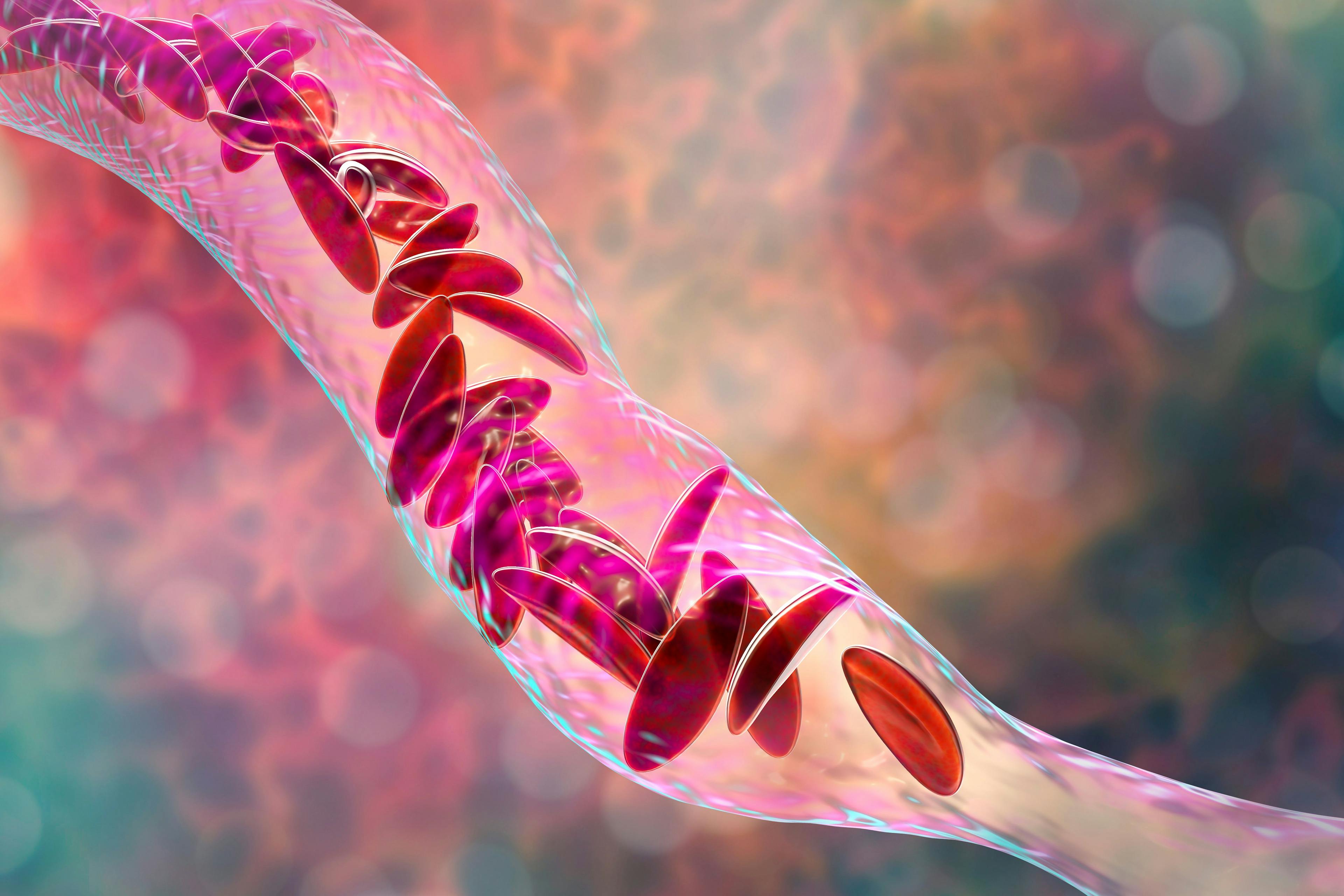Sickle cell anemia, 3D illustration. Clumps of sickle cell block the blood vessel | Image Credit: Dr_Microbe - stock.adobe.com