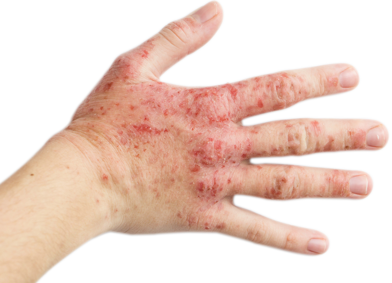 Tralokinumab-ldrm Shows Significant Improvements in Symptoms of Atopic Dermatitis 