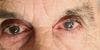 Glaucoma: Repercussions in the Older Adult