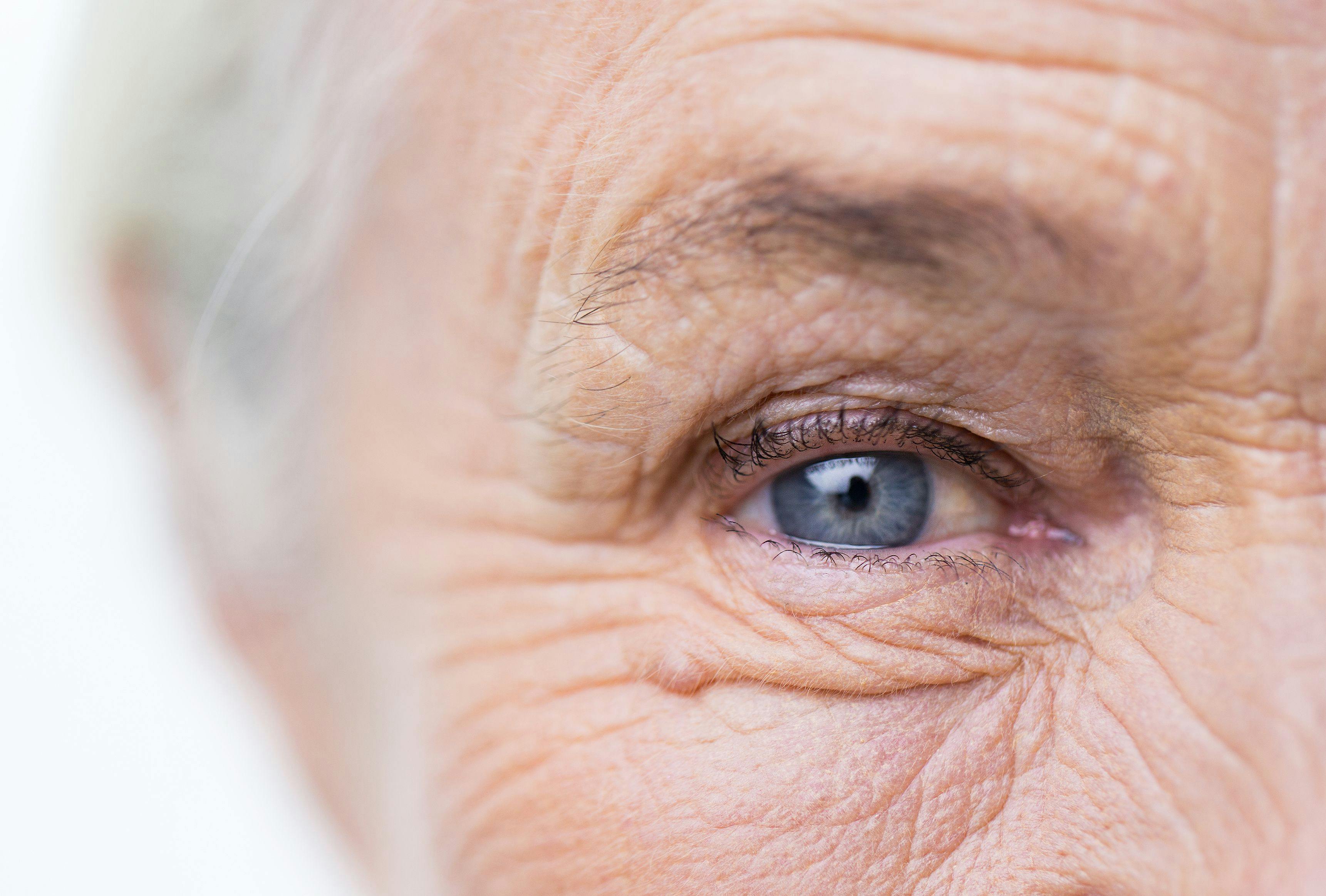 Specific Form of Age-Related Macular Degeneration Linked to Heart Disease and Stroke
