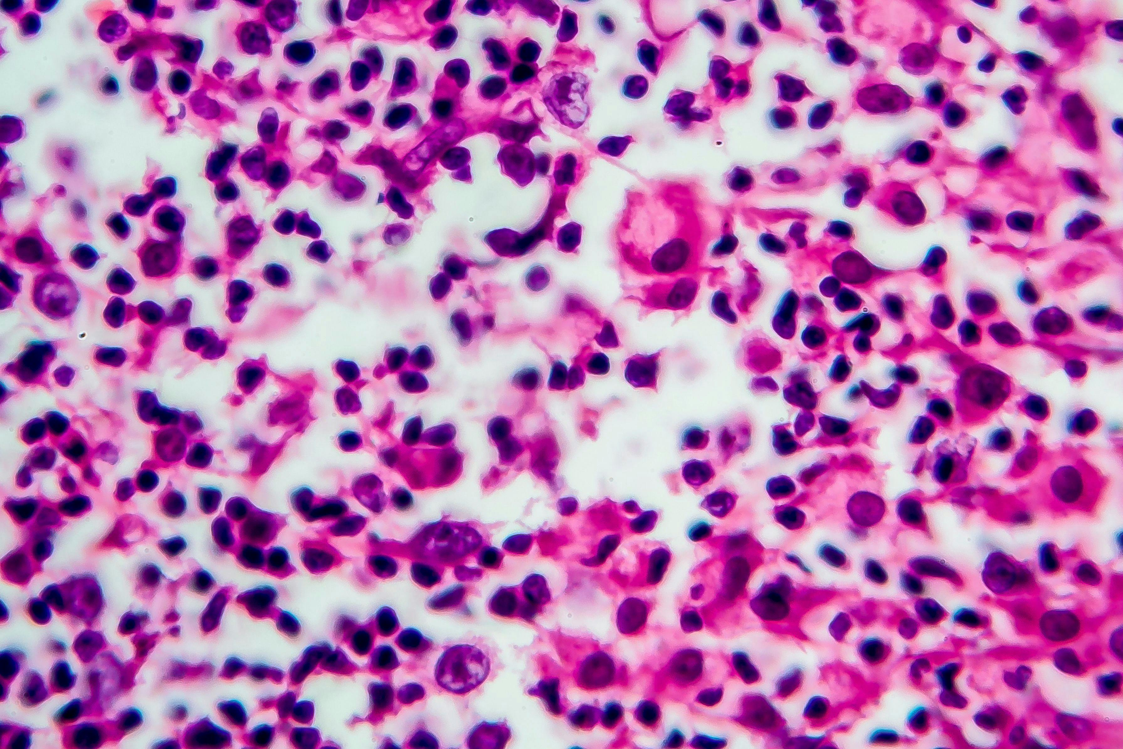 Hodgkin's lymphoma, light micrograph, photo under microscope