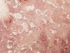 Psoriatric Arthritis More Prevalent in Psoriasis Patients Than Previously Believed