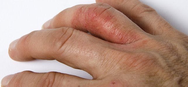 Psoriasis Drug Guselkumab Shows Durable Skin Clearance Through 5 Years for Adults